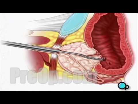 TURP Transurethral Resection Prostate Surgery, patient education series