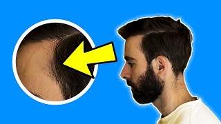 ¿Qué es el Cabello Miniaturizado Todo lo que Debes Saber