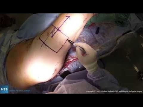 Image - PRECICE Femur Lengthening: Live Surgery