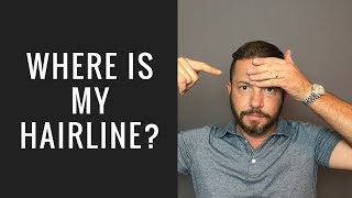 Hair Replacement Hair System Review Where is My Hairline?