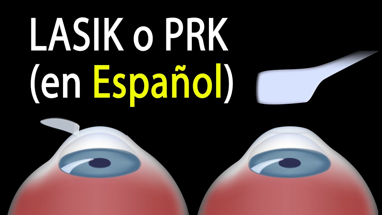 Watch LASIK o PRK Cuál es el adecuado para mí Alila Medical Media Español. Now LASIK o PRK Cuál es el adecuado para mí Alila Medical Media Español.
