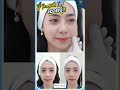 เมโสแฟต ยี่ห้อไหนดี