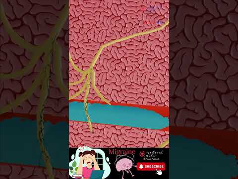 Migraine Treatment: How does it work?