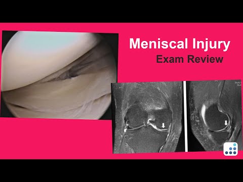 Meniscal Injury Exam Review - Raymond Kim, MD