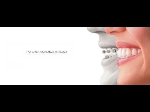 Invisalign Experience (Braces) : Explanation, Before and After | Seoul Guide Medical