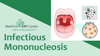INFECTIOUS MONONUCLEOSIS - #GLANDULAR FEVER, #MONO, #drrajeshbhardwaj #sorethroat #Tonsillitis