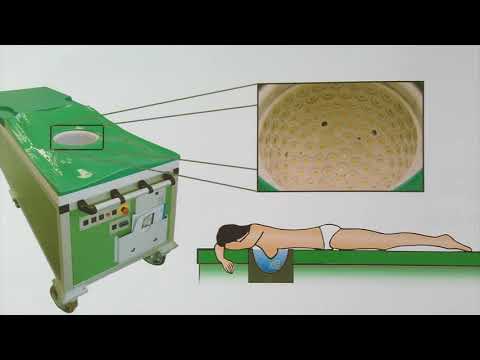 Wunder unterer Rücken zieht den Bauch 40 Wochen schwanger Ist Massage gut für zervikale degenerative Bandscheibenerkrankungen