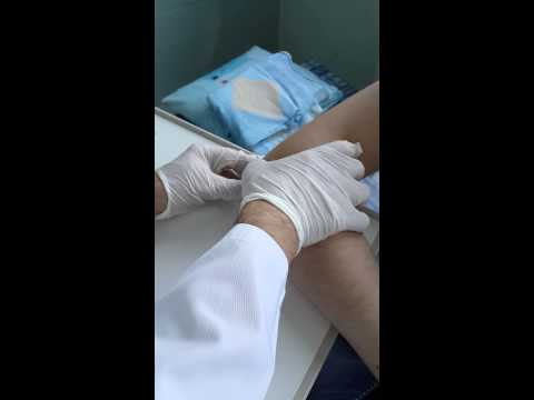 Повреждение мыщелка коленного сустава лечение Спорт после операций на плечевом суставе