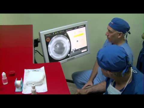 Catalys Laser Cataract Surgery System - MDEA 2012 Finalist
