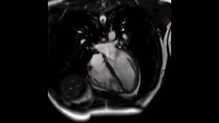 cardiac MRI scan , blood flow through the heart and systemic circulation !!!