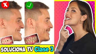 💊 Tratamiento para 𝗠𝗢𝗥𝗗𝗜𝗗𝗔 𝗜𝗡𝗩𝗘𝗥𝗧𝗜𝗗𝗔 clase 3 en NIÑOS y ADULTOS (MORDIDA CRUZADA ANTERIOR)