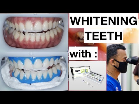 Dental Whitening Procedure Natural Bright Smile with Beyond Kit