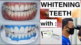 Dental Whitening Procedure Natural Bright Smile with Beyond Kit | General Dentist Griya RR