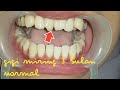 Terlengkap  Bulan Pemasangan Behel Gigi Sudah Rapi, Video Harapan!