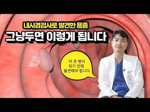 내시경검사로 발견한 용종 그냥두면 이렇게 됩니다