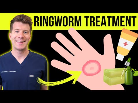 Doctor explains HOW TO TREAT RINGWORM (jock itch/athletes foot) | Medications plus natural remedies