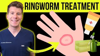 Doctor explains HOW TO TREAT RINGWORM (jock itch/athletes foot) | Medications plus natural remedies