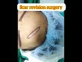 Sacr revision surgery #scar #scartreatment #cosmeticsurgery #plasticsurgery #drsanjibtripathee