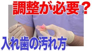 粘膜と接している部分の入れ歯の汚れがひどいときは？