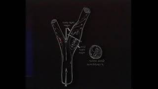 Carotid MRI