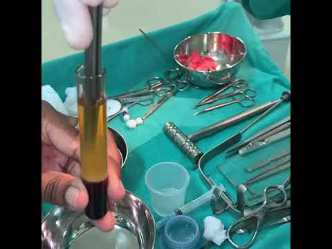 Platelet Rich Fibrin For Various Maxillofacial Surgeries