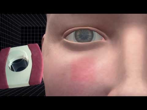 Tooth implanted into the eye to restore vision