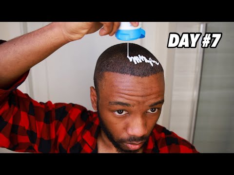 DAY 7 AFTER MY HAIR TRANSPLANT👨🏾‍🦲‼️