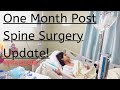 One Month Post Spine Surgery Update! (With Scars)