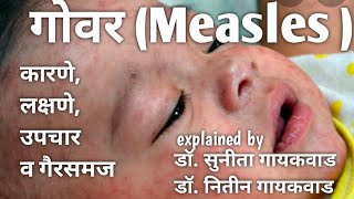गोवर (Measles )-कारणे, लक्षणें, उपचार व गैरसमज