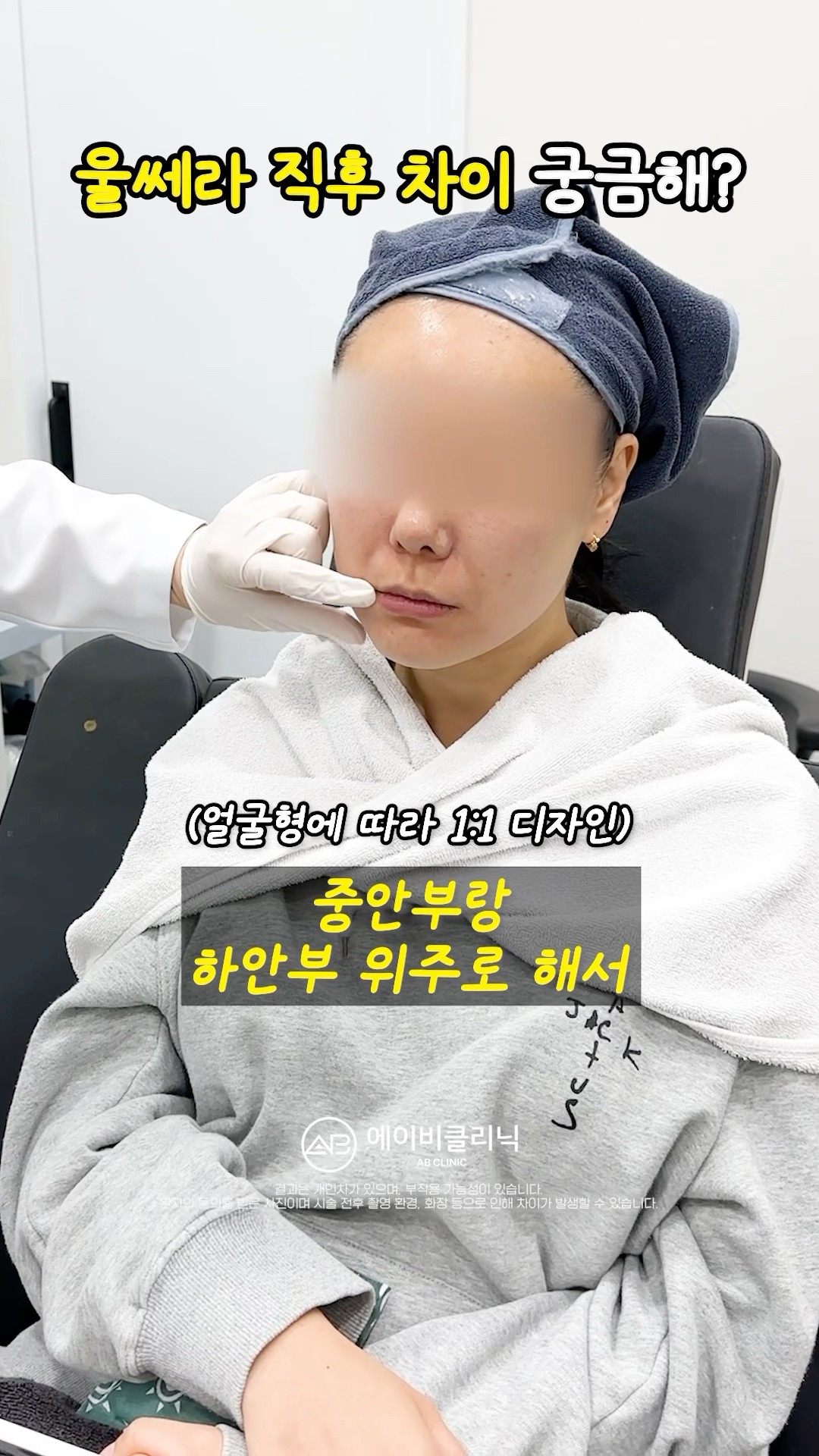 착붙 V라인 울쎄라 후기 🫶