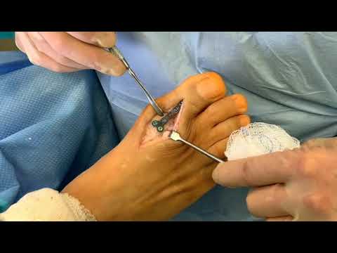 How Long Until You Can Walk Normally After a Bone Graft Surgery ASK DR MOORE