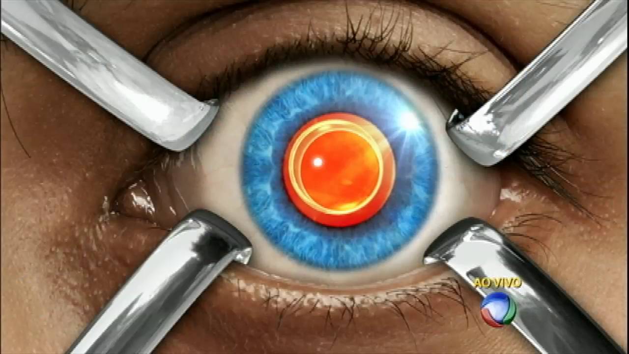 Saiba tudo sobre catarata e glaucoma no Você e o Doutor