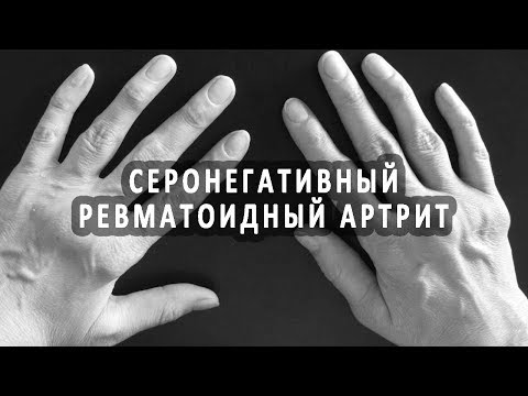 Шейный отдел позвоночника смещение симптомы Смесь сальникова при остеохондрозе