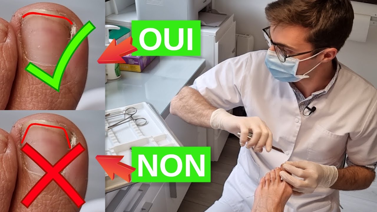 Comment se couper les ongles des pieds  (et éviter les ongles incarnés)