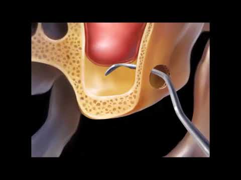 SINUS LIFT, podniesienie dna zatoki szczękowej