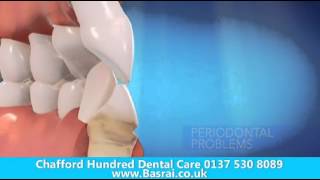 preview picture of video 'Invisalign Dentist Grays Essex - Call 01375 48 1000  Invisalign Dentist in Grays'