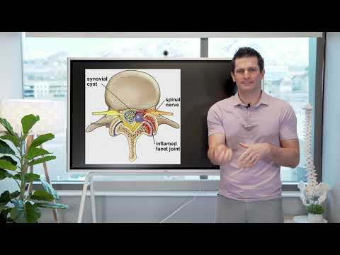 Synovial cyst // what you need to know