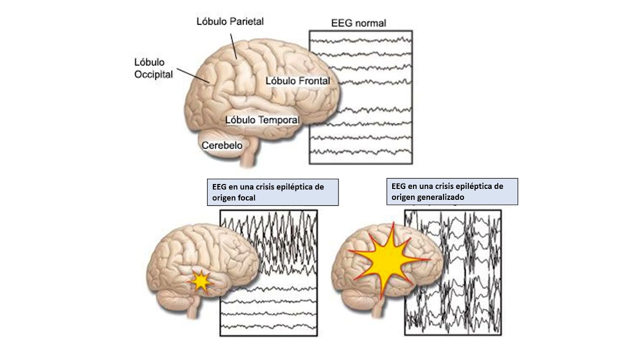 Fisiopatología de Crisis Epilépticas