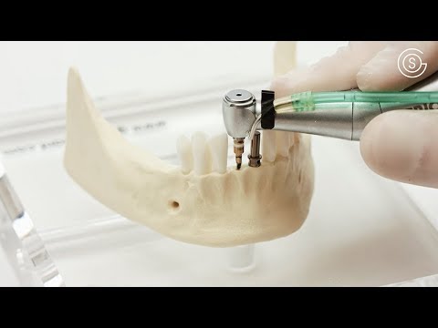 Implantation von zwei durchmesserreduzierten Implantaten am Modell Mandibula B6 bone by GOS®