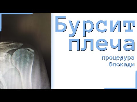 блокада плечевого сустава при калькулезном бурсите