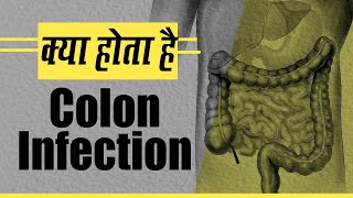 Colon Infection: Meaning, Causes And Symptoms
