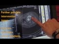 Amedo Laser Navigation System For CT Guided Interventions