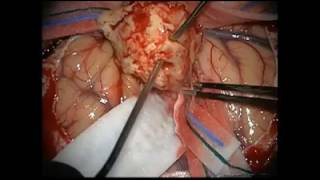 Operacja na otwartym odbycie