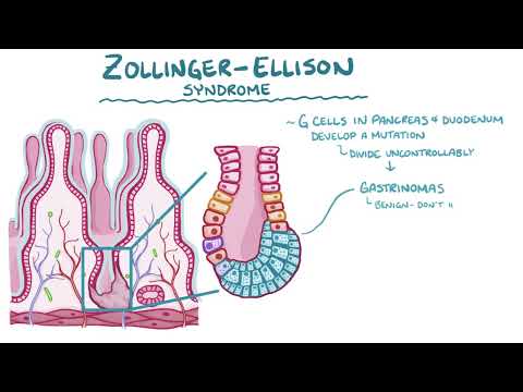 zollinger Ellison syndrome