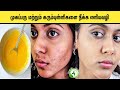 Amazing Home Remedies to Get Rid of Blackheads on Face Remove Pimple - Acne