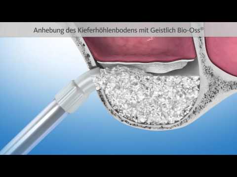 Bone augmentation with sinus lift | Patient information