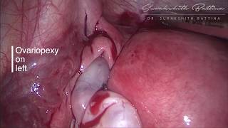 Download lagu Modified ovariopexy for recurrent torsion mp3