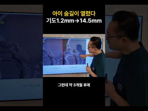 아이 수면무호흡, 수술 없이 기도 1.2→14.5mm