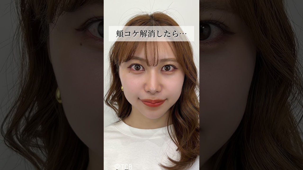 【糸リフト】頬コケ解消したろ… #shorts