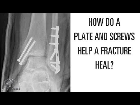 How does a Plate and Screws Help a Broken Bone Heal